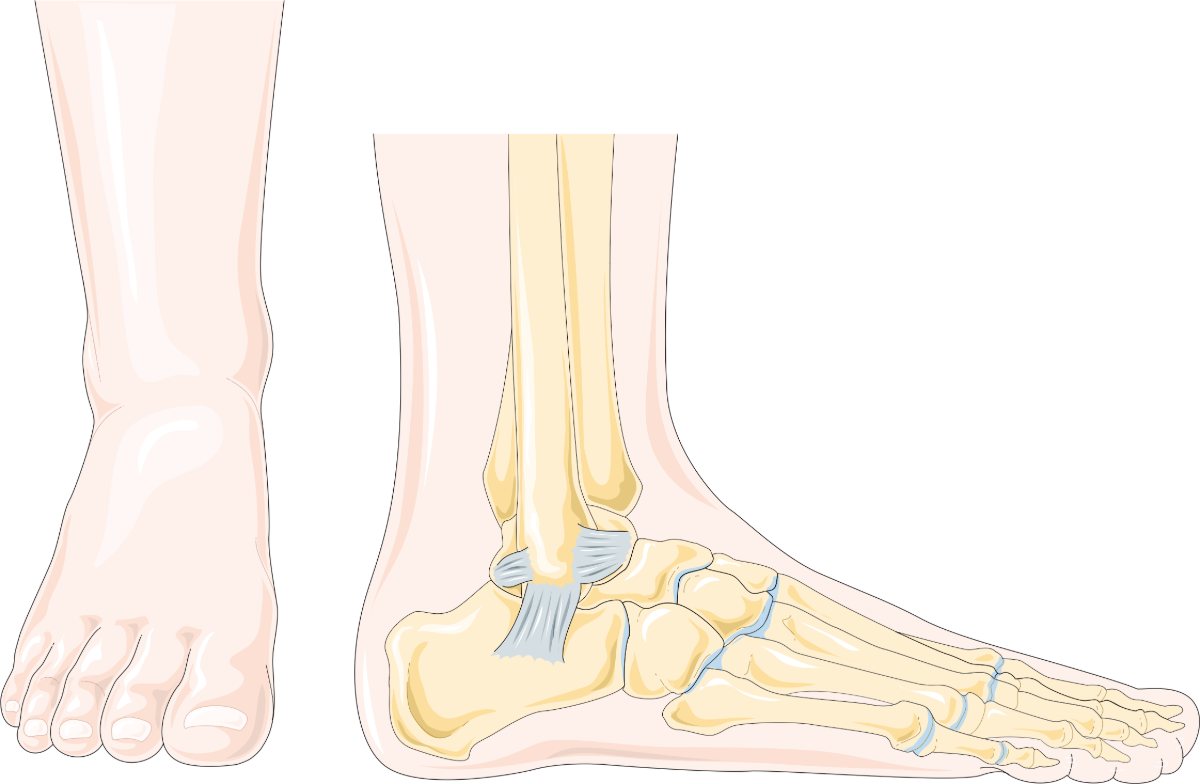 Ilustración del pie y el tobillo con el ligamento lateral dañado en un esguince.