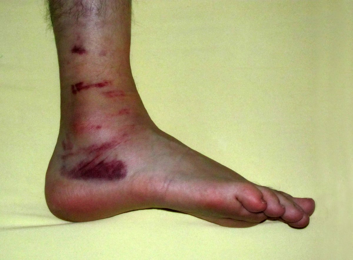 Tobillo hinchado y con hematoma en la cara externa después de un esguince.